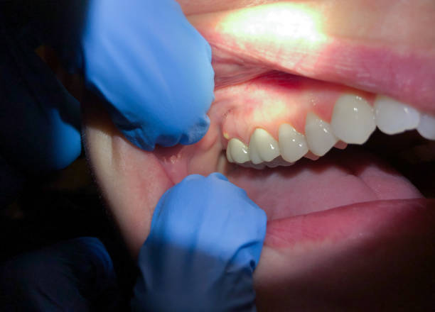 Emergency Dental Filling Replacement in TX